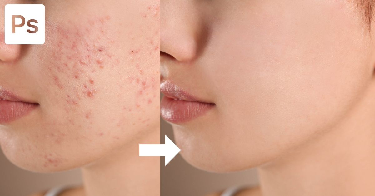 How To Remove Acne & Blemishes In Photoshop